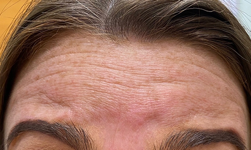 Botox Before and After | Princeton Plastic Surgeons