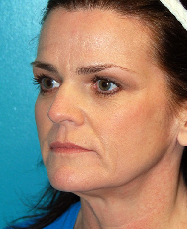 Facelift Before and After | Princeton Plastic Surgeons