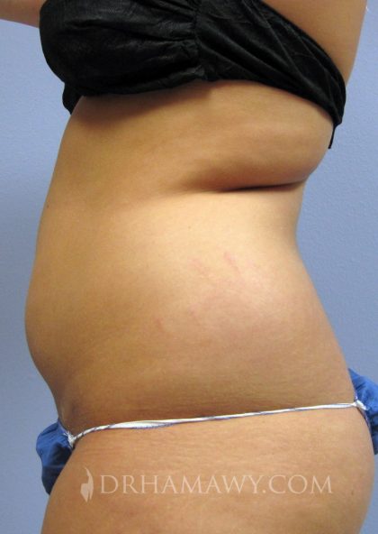 Liposuction Before and After | Princeton Plastic Surgeons