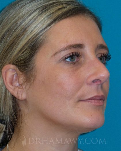 Rhinoplasty Before and After | Princeton Plastic Surgeons