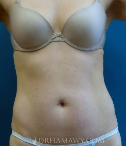 Smartlipo Before and After | Princeton Plastic Surgeons