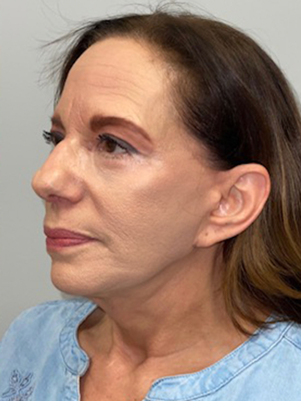 Eyelid Surgery Before and After | Princeton Plastic Surgeons