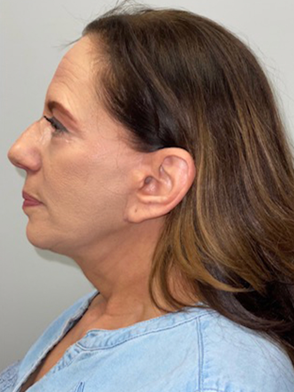 Eyelid Surgery Before and After | Princeton Plastic Surgeons