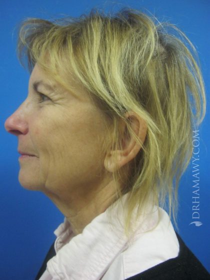 Facelift Before and After | Princeton Plastic Surgeons