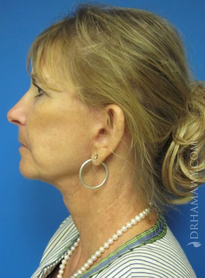 Facelift Before and After | Princeton Plastic Surgeons