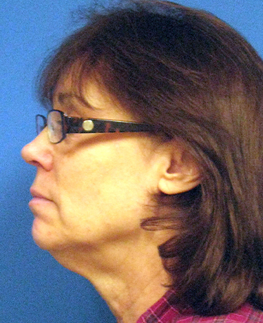 Facelift Before and After | Princeton Plastic Surgeons