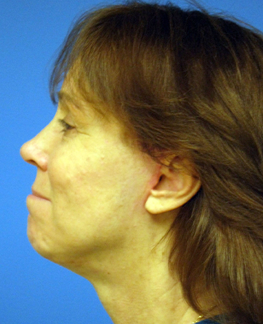 Facelift Before and After | Princeton Plastic Surgeons