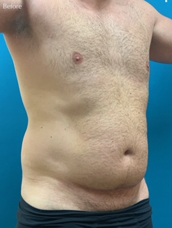 Liposuction Before and After | Princeton Plastic Surgeons