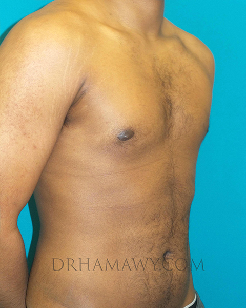 Male Chest Enhancement Before and After | Princeton Plastic Surgeons