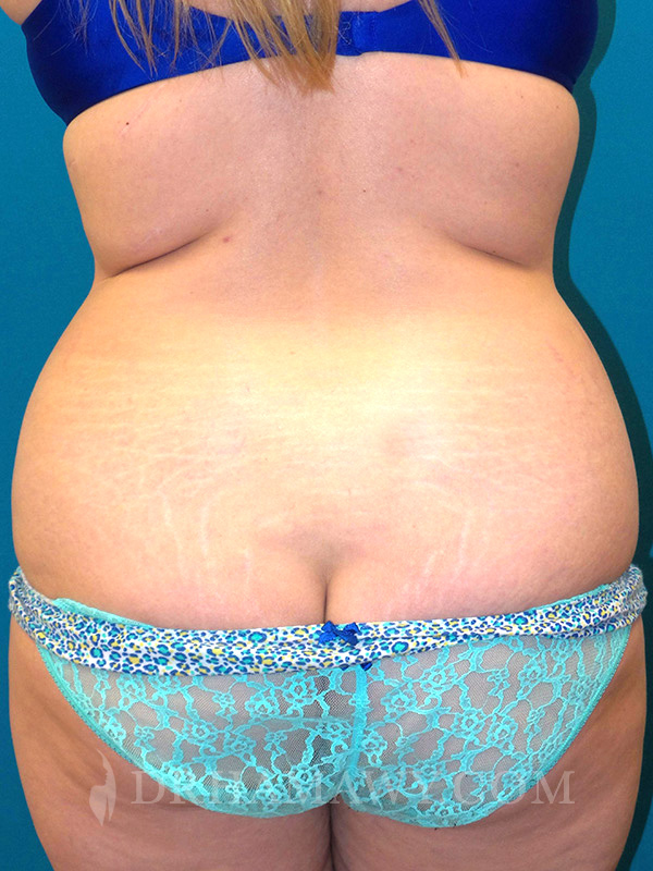 Tummy Tuck Before and After | Princeton Plastic Surgeons