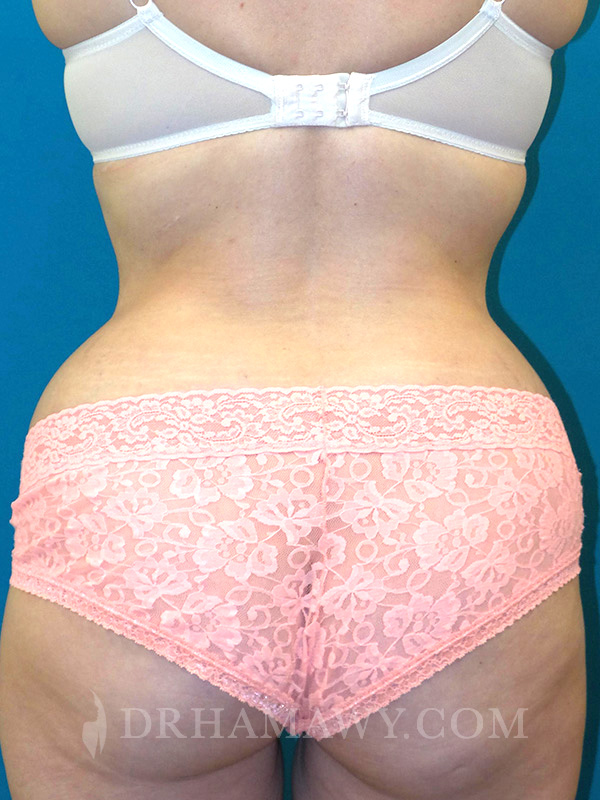 Tummy Tuck Before and After | Princeton Plastic Surgeons