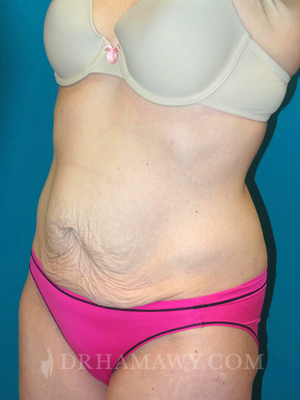 Tummy Tuck Before and After | Princeton Plastic Surgeons