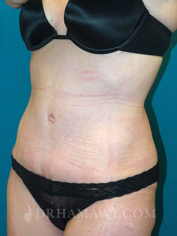 Tummy Tuck Before and After | Princeton Plastic Surgeons