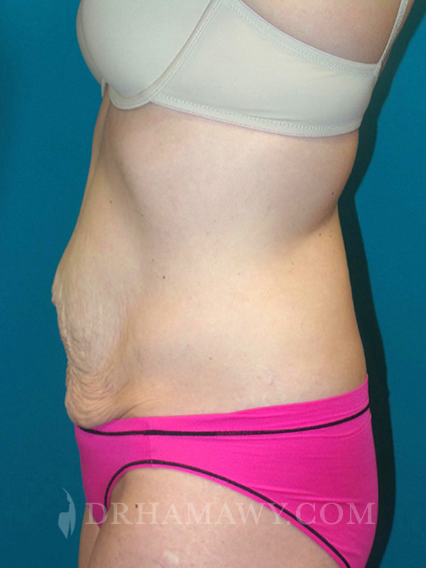 Tummy Tuck Before and After | Princeton Plastic Surgeons