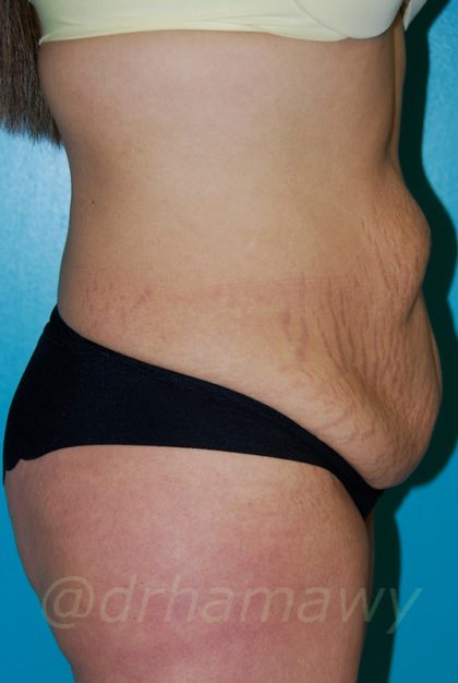 Tummy Tuck Before and After | Princeton Plastic Surgeons